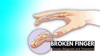 Broken finger Causes Signs and Symptoms Diagnosis and Treatment [upl. by Ahseele]