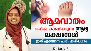 ആമവാതം ശരീരം കാണിക്കുന്ന ആദ്യ ലക്ഷങ്ങൾ  Amavatham treatment  Dr Jasla P [upl. by Farrington]