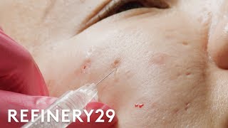 I Got Fillers For My Acne Scars  Macro Beauty  Refinery29 [upl. by Nnayram]