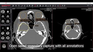 MedDream DICOM Viewer saving viewport content as DICOM secondary capture [upl. by Diandra]