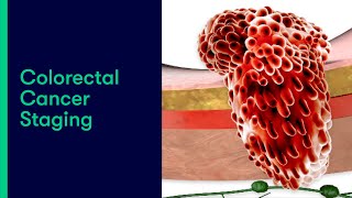 Colorectal Cancer Staging [upl. by Michigan]