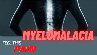 Feel This Pain S3E3 Myelomalacia [upl. by Lraep]