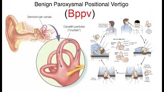 Vertigo Treatment with Simple Exercises BPPV Brandt Daroff exercises [upl. by Placia]