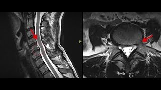 Bulging Discs Causes and Treatment [upl. by Mont981]