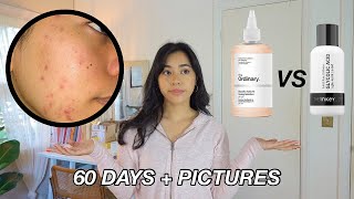 The Ordinary Glycolic Acid 7 Toning Solution VS The Inkey List Glycolic Acid Toner 60 days  pics [upl. by Vonni212]