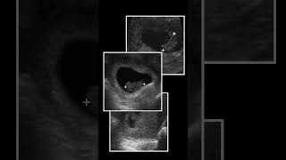 Ultrasound Progression of the 1st Trimester pocus ultrasound [upl. by Bridgette]