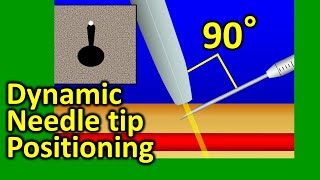 Ultrasound guided dynamic needle tip positioning in peripheral vein and artery cannulation [upl. by Olympie]