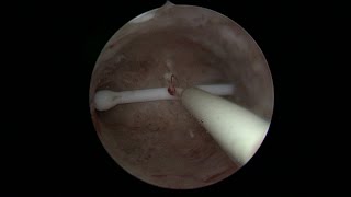 Le retrait dun stérilet  hystéroscopie  Dr Ahmed SKHIRI  Hysteroscopic removal of IUD [upl. by Ennovart438]