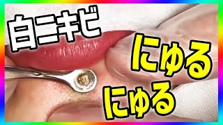 ニキビの潰し方・圧出法（にゅるにゅる系動画）acne treatment acne removal 粉刺 [upl. by Kcir]