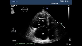 Typical Appearance for arrhythmogenic right ventricular dysplasiacardiomyopathyARVDARVC [upl. by Atinel932]