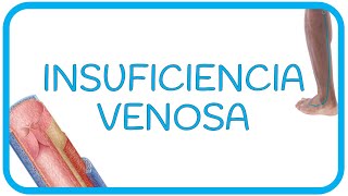 INSUFICIENCIA VENOSA  Causas fisiopatología síntomas diagnóstico y tratamiento  CIRUGÍA [upl. by Zindman511]