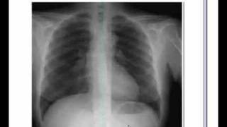 Respiratory system X ray Chest Pneumonia [upl. by Kreis]