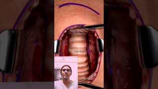 Tracheostomy SurgeryTracheotomy procedure [upl. by Fowkes]