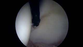 Debridement of Hyperplastic Labrum Prior to Surgical Repair [upl. by Ailido]