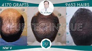 Injerto Capilar Técnica FUE – 4170 Grafts 9653 Pelos – Dr Rafael de Freitas [upl. by Eiltan]