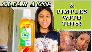 HOW TO USE DETTOL ANTISEPTIC LIQUID TO CLEAR YOUR ACNE clear your pimples in 3 days enoblee3152 [upl. by Ahsoet]