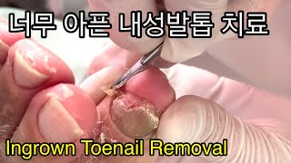 10년 묵은 체증이 내려가는 내성발톱 12 차 치료 덤으로 고랑이 청소 Ingrown toenail removal [upl. by Nhguavad]