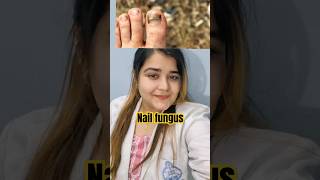 toenails podologia fungus trending nails infection treatment youtubeshorts foryou skincare [upl. by Airot]