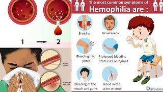 Hemophilia  Introduction Clinical Features Investigation and Management [upl. by Ketty]