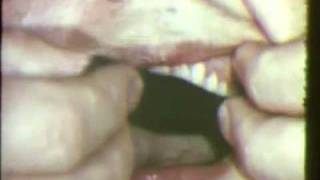 Occlusal Adjustment Part I Centric [upl. by Downall644]