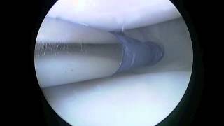 lateral meniscus repair [upl. by Libbie]