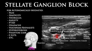 Stellate Ganglion Block  How and Why  UltrasoundGuided Technique and Outcome [upl. by Peonir773]