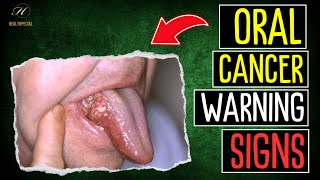 MOUTH Cancer Symptoms  Early Signs of ORAL Cancer [upl. by Pol]