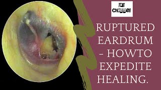 Ruptured eardrum I what should you do after traumatic perforation of tympanic membrane [upl. by Lynnett739]