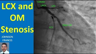 LCX and OM Stenosis [upl. by Bullock]