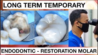 Dental Endodontic Direct Restoration Long Term Temporary Composite  General Dentist Griya RR [upl. by Irahcaz140]