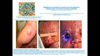 HUMAN M pox Monkeypox Infection And Morbidity Persist Since The Recent Global Outbreak [upl. by Darach]