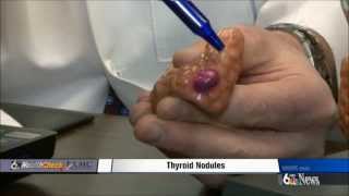 Thyroid Nodules [upl. by Higbee]