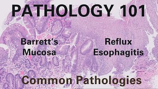 Reflux Esophagitis amp Barretts Esophagus  Pathology 101 [upl. by Donaugh550]