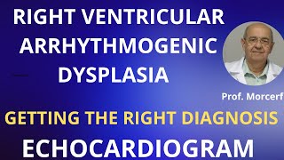 RIGHT VENTRICULAR ARRHYTHMOGENIC DYSPLASIA [upl. by Julita]