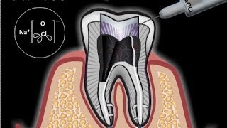 Was ist eine Wurzelbehandlung [upl. by Edmonds]