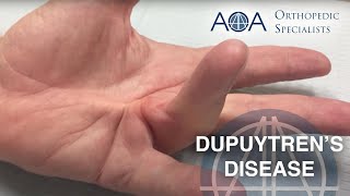 AOA Orthopedic Specialists  Dupuytrens Contracture [upl. by Arahsat318]