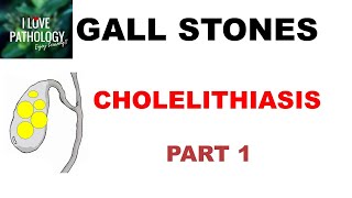 CHOLELITHIASIS GALL STONESPart 1 Epidemiology Types Risk factors [upl. by Nuawtna]