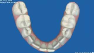 Invisalign Express OrthodonticsBefore amp AfterMick Family Dental [upl. by Kora]