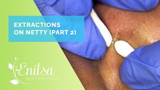 Blackhead Extractions on Netty  Second Treatment [upl. by Hedaza]