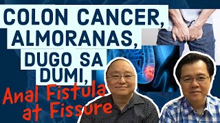 Colon Cancer Almoranas Dugo sa Dumi Anal Fistula at Fissure  Payo ni Doc Willie Ong 188 [upl. by Klug]