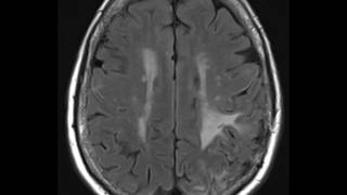 Amyloid Angiopathy [upl. by Adnorahs33]