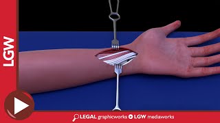 Wrist Fixator Surgery 3D Animation [upl. by Akeem]