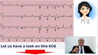 EKG Trainer Case 3 Answer [upl. by Sigsmond295]