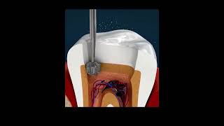 Heal Your Teeth Naturally The Science Behind Remineralization of Teeth [upl. by Ymia937]