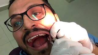 Upper left wisdom self extraction procedure [upl. by Duong]