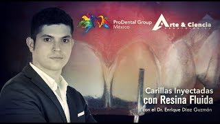 ►Carillas Inyectadas con Resina Fluida  Dr Enrique Díaz Guzmán [upl. by Peugia411]