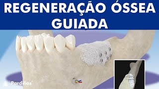 Regeneração óssea guiada  Enxerto ósseo © [upl. by Enyleuqcaj]