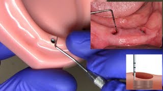 Measuring Tissue Height for LOCATOR and LOCATOR RTx Abutments [upl. by Reyna]