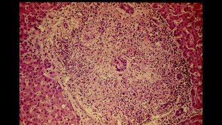 Primary Biliary Cirrhosis  Pathology mini tutorial [upl. by Linden]