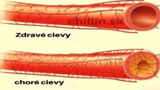 Liek na prečistenie upchatych ciev a zníženie cholesterolu [upl. by Hepsibah]